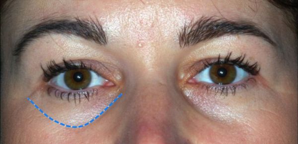 hogyan lehet eltávolítani a szem alatti zsírpárnákat