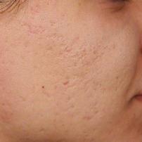Fractional carbon dioxid laser treatment of acne scars