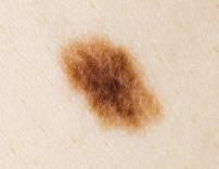 Mole or melanoma screening with dermoscopy