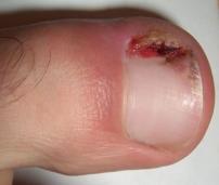 Ingrow nail operation