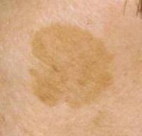 Removal of age spot