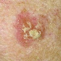 Removal of actinic keratosis