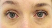 Treatment of dark eye cicrles
