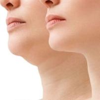 Double chin treatment with Aqualyx injection