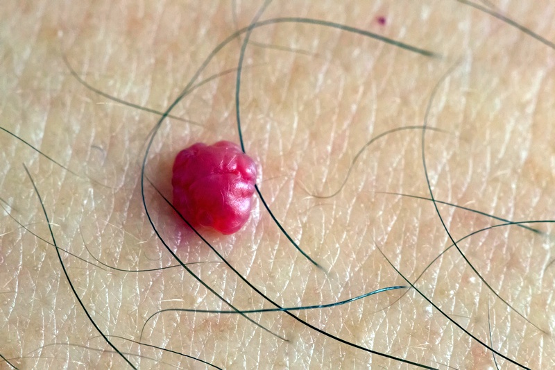 Ércsomó (hemangioma) széndioxid lézerrel történő eltávolítása