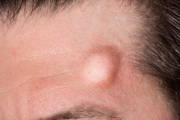 Atheroma (kásadaganat) széndioxid lézerrel történő eltávolítása