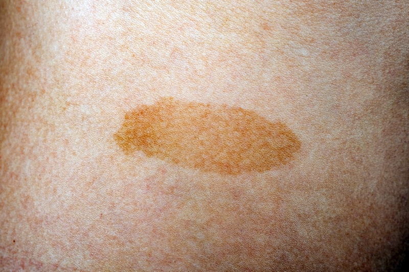 Időskori pigmentfoltok (lentigo senilis) széndioxid lézerrel történő eltávolítása