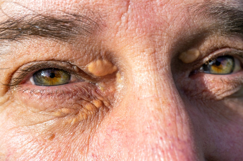 Xanthelasma palpebrarum széndioxid lézerrel történő eltávolítása