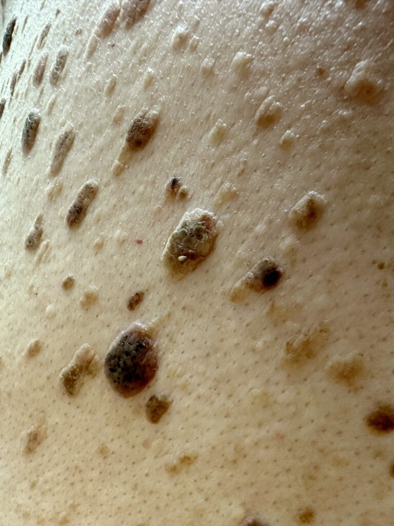 Keratosis seborrhoica (időskori szemölcs) széndioxid lézerrel történő eltávolítása