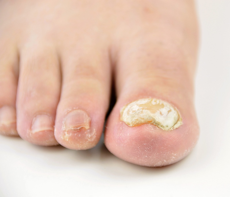 Treatment of onychomycosis with Q-switched lasers
