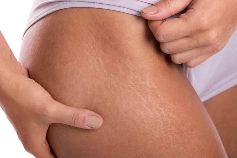 Fractional carbon dioxid laser treatment of stretch marks
