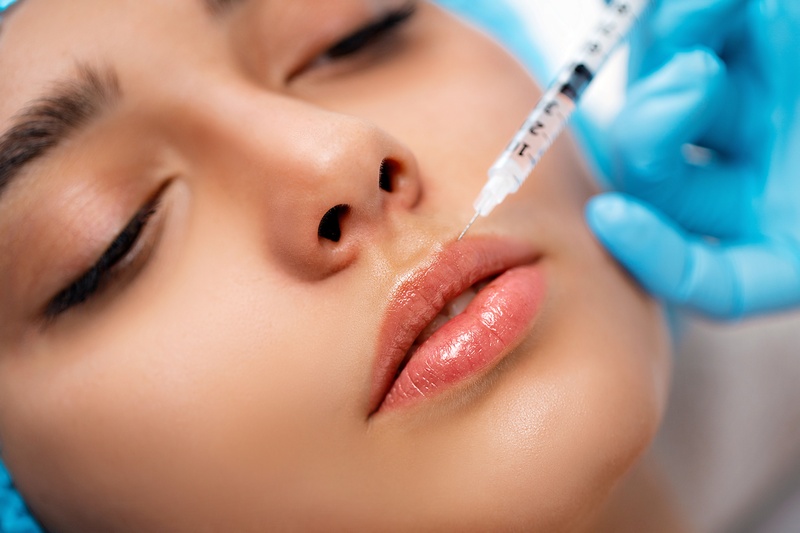 Lip filling with hyaluronic acid in the case of lip thinning