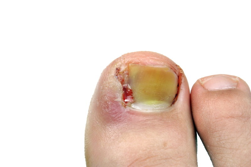 Ingrown nail surgery with carbon dioxide laser