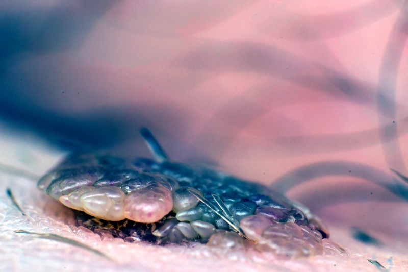 Genital wart (Condyloma) removal with carbon dioxide laser