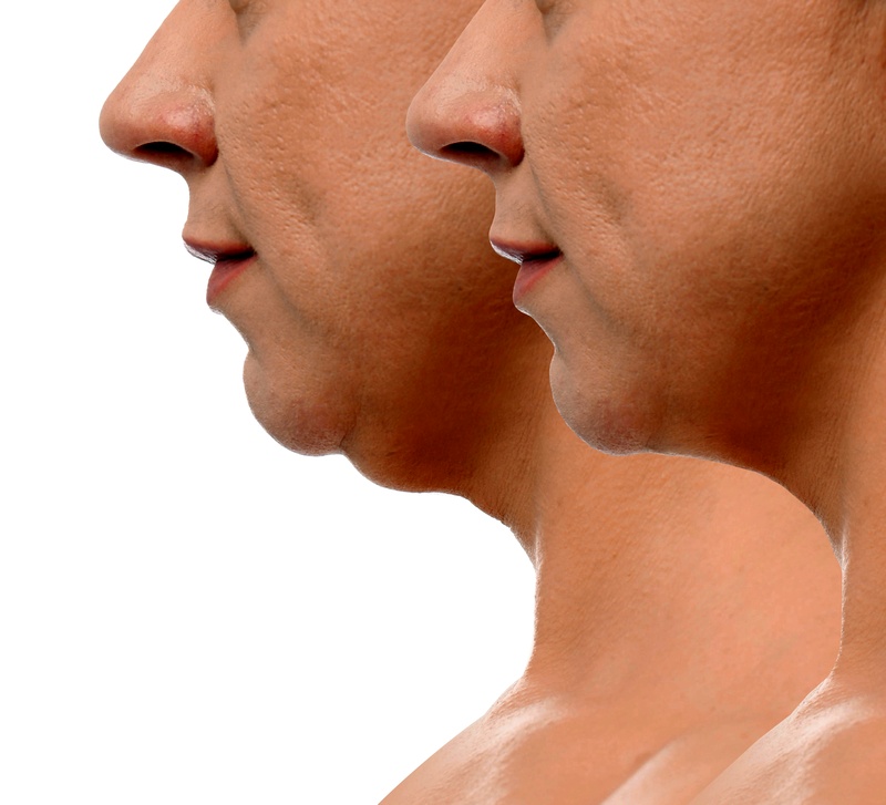 Double chin treatment with fat burning Aqualyx injection