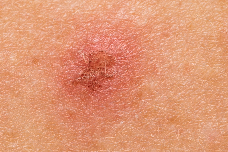 Actinic keratosis removal with carbon dioxide laser