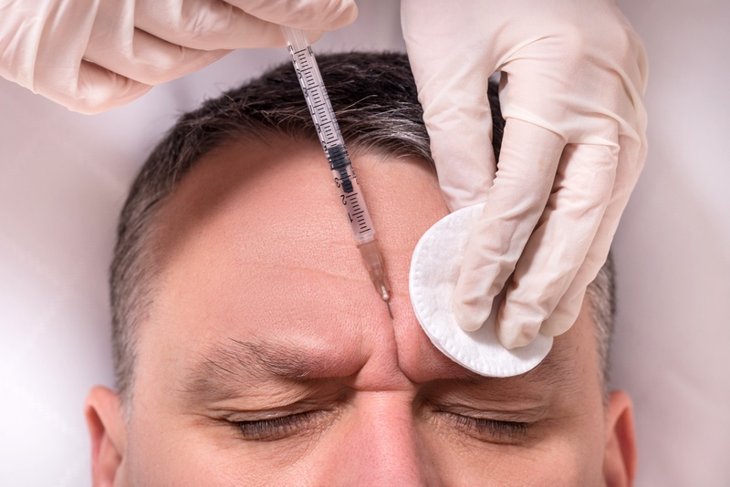 Static wrinkles filling with hyaluronic acid