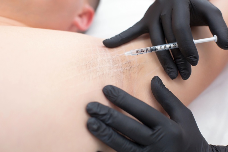 Botox treatment of increased axillary hyperhydrosis