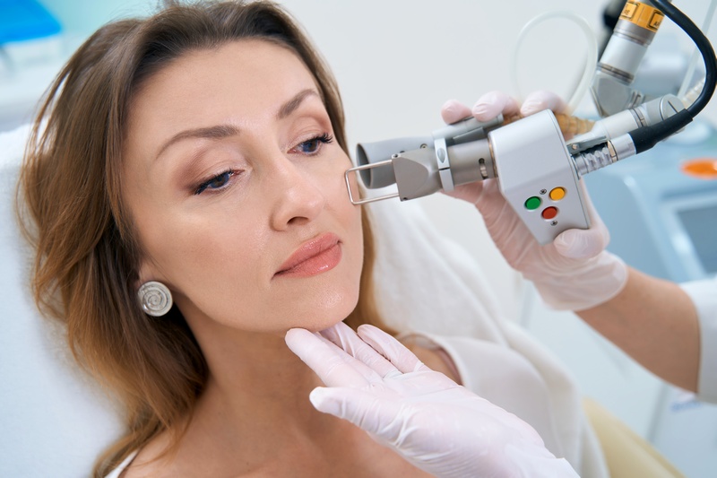 Fractional carbon dioxide laser treatment of acne scars
