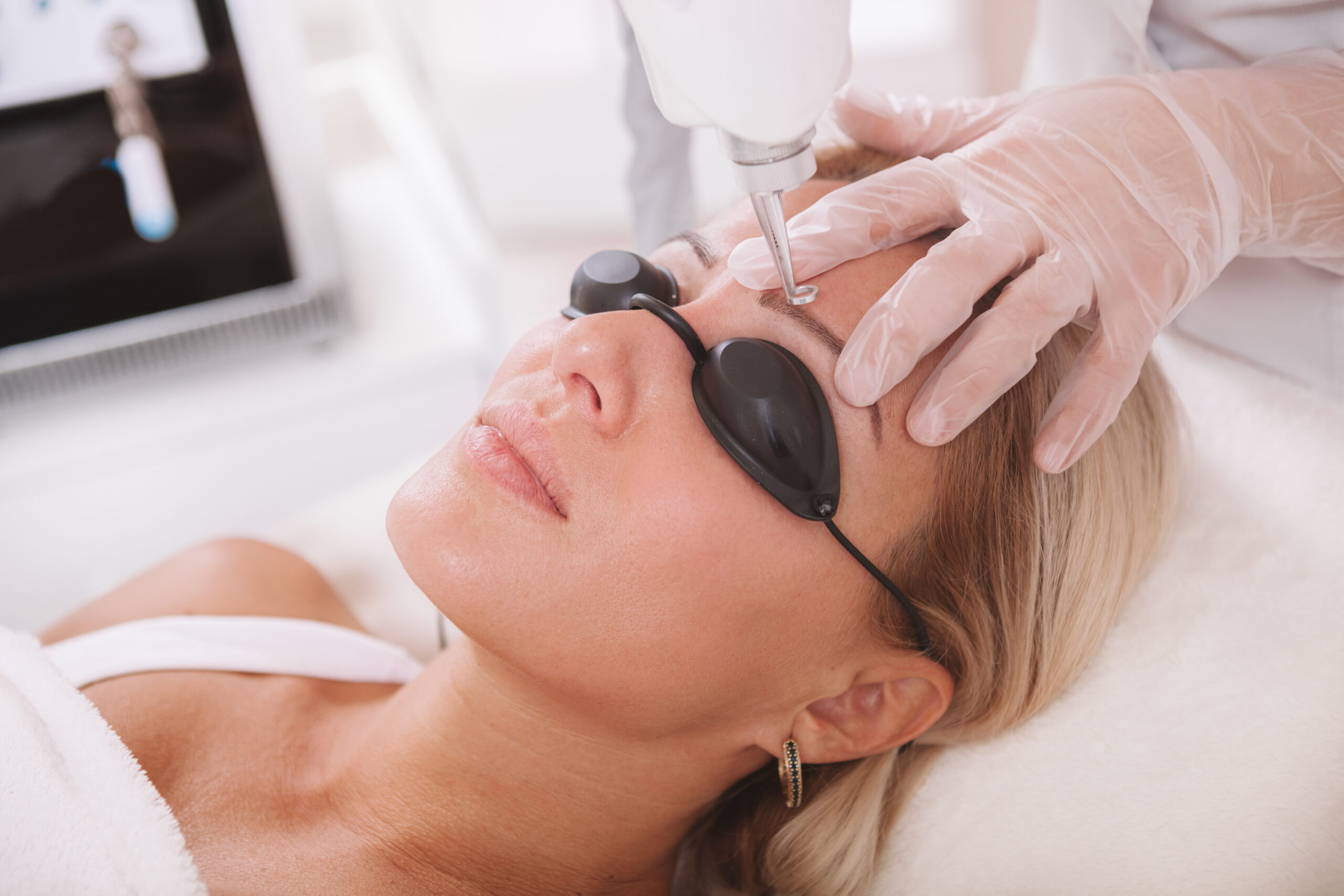 Eyebrow tattoo removal with Q-switched Nd YAG laser