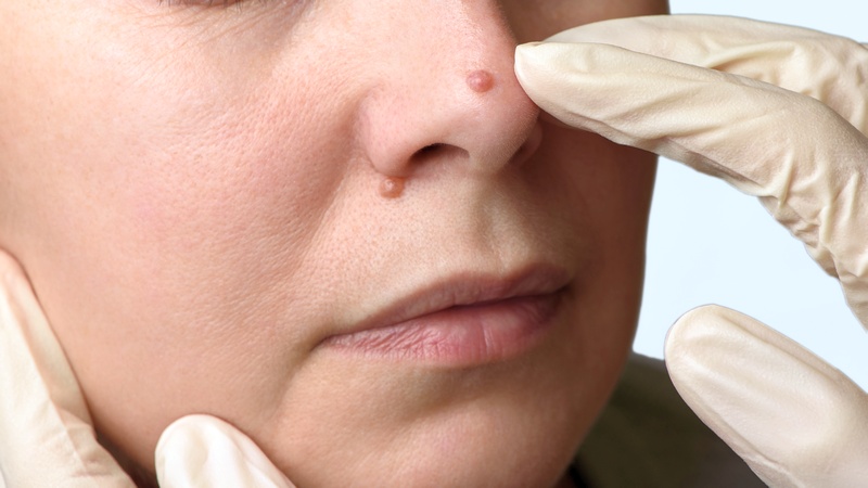 Wart and skin tag removal with carbon dioxide laser