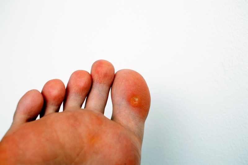 Corn removal with carbon dioxide laser