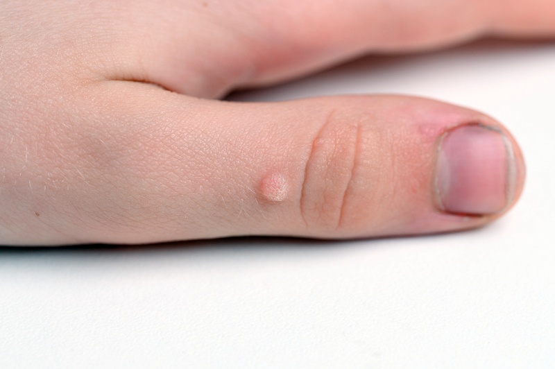 Viral wart removal with carbon dioxide laser