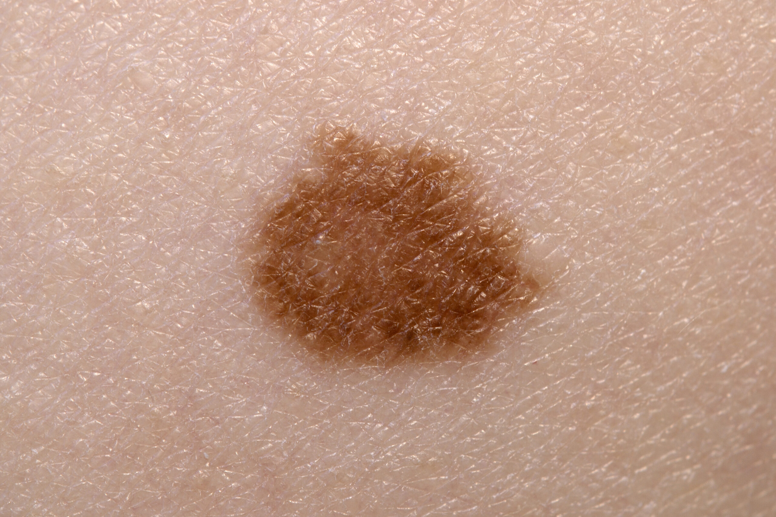 Mole or melanoma screening with dermoscopy