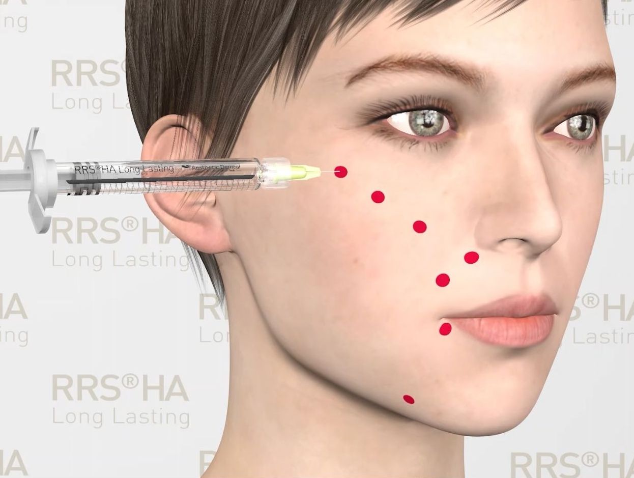 Spanish Glow LoLa kezelés: tartós hidratálás, liftinghatás és bőrmegújítás egyetlen kezeléssel